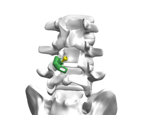 TFFS translaminar connector