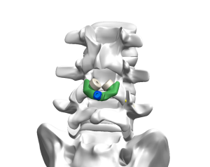 TFFS spine transfacet fixation