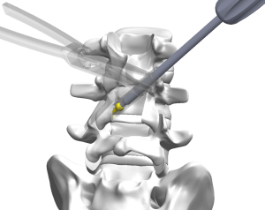 TFFS facet fixation